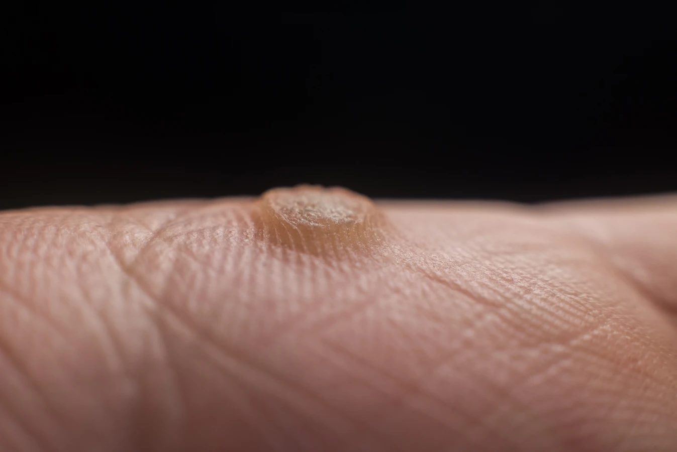 Jak się pozbyć kurzajki?