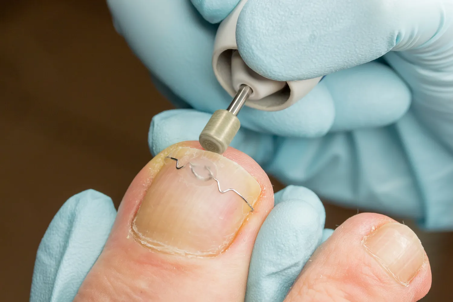 Wrastające paznokcie Szczecin