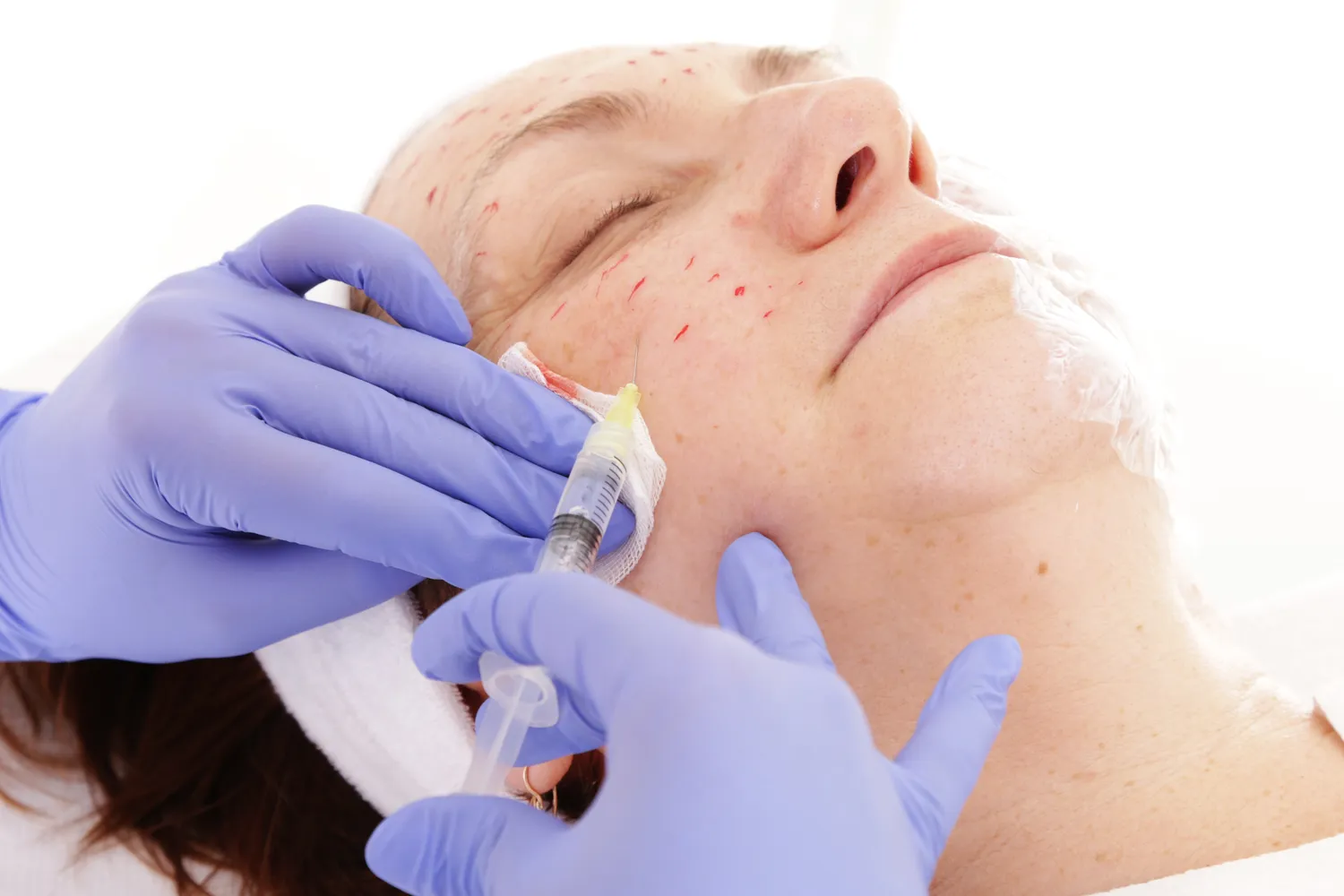 Co lepsze na zmarszczki kolagen czy kwas hialuronowy?