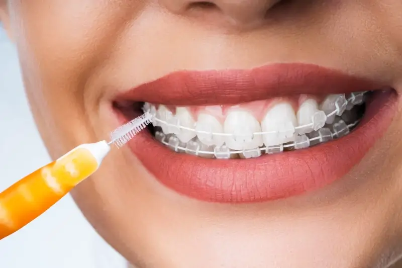 Licówki porcelanowe ranking Szczecin